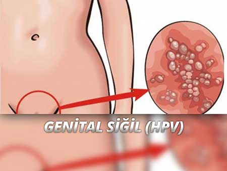 Hpv nin tedavisi - Hpv enfeksiyonlar nedir, HPV virüsü nedir? los oxiuros que es